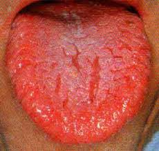 red cracked tongue